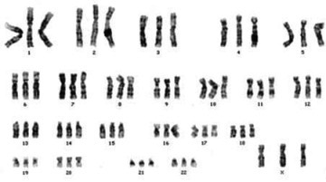 Hromozomi triploidije