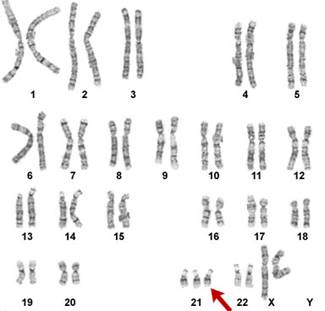 Kariotip osobe koja ima Downov sindrom