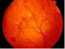 hipertenzivna retinopatija 