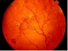 hipertenzivna retinopatija
