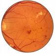 neproliferativna dijabeticka retinopatija