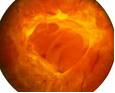 proliferativna dijabeticka retinopatija