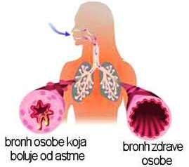 Bronh zdrave osobe i osobe koja bolje od astme