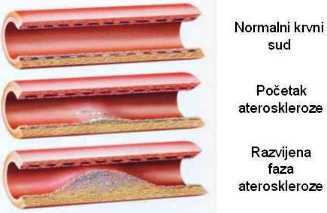 Holesterol i arterioskleroza