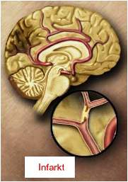 Infarkt mozga