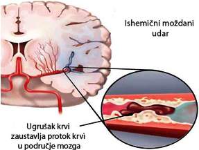 Ishemijski mozdani udar
