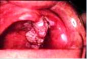 Karcinom usne