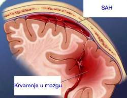 SAH  - subarahnoidalno krvarenje