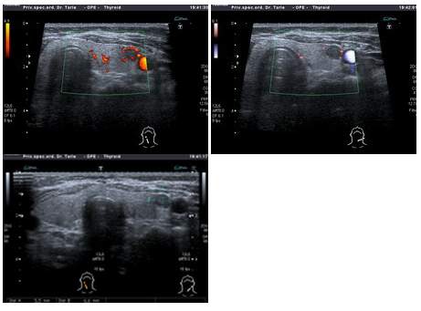 Ultrazvucni pregled štitnjace 
