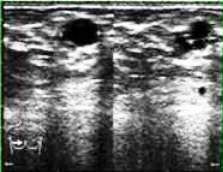 Ultrazvucni snimak pojedinacne i grupisanih cista u dojci