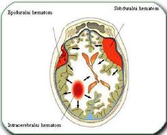 Compresio cerebri