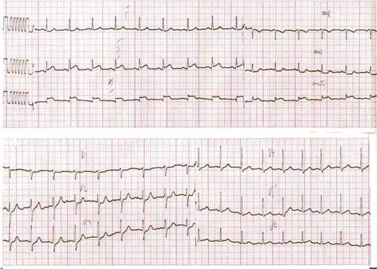 EKG infarkta