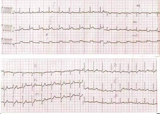 EKG infarkta