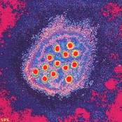 Hepatitis A 