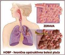 Hronicna obstruktivna bolest pluca