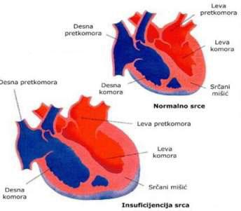 Primarna plućna hipertenzija