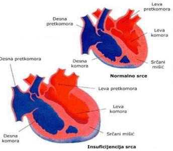 povecan pritisak u desnoj komori