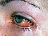 Konjunktivitis