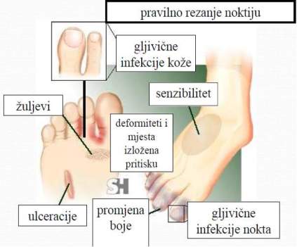 Pregled dijabetickog stopala