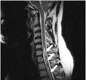 Syringomyelia i syringobulbia