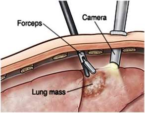 VATS