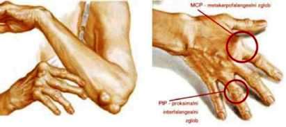 Zglobovi zahvaceni reumatoidnim artritisom