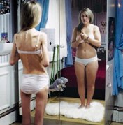 Anoreksija nervosa