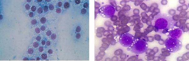 Citološki nalaz karakteristicnih celija transmisivnog venericnog tumora 